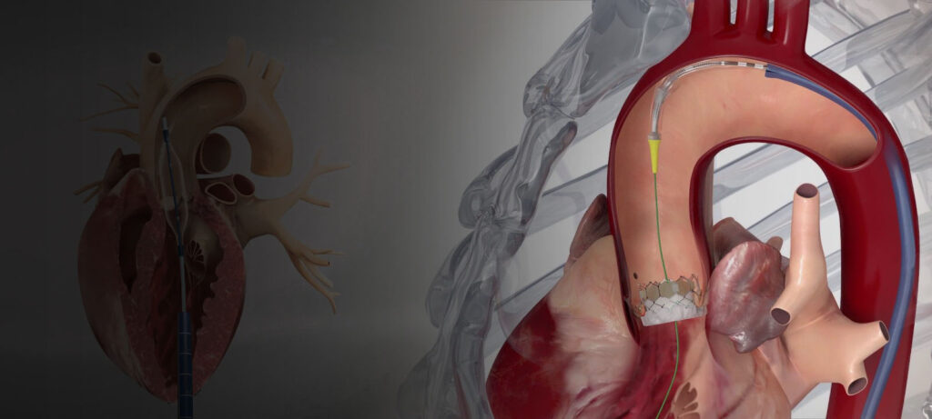 What is TAVR