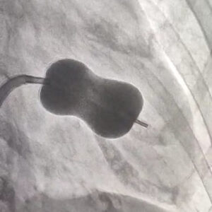 BMV Balloon Mitral Valvotomy