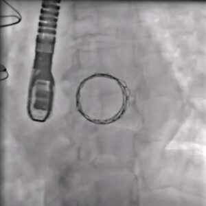 Transcatheter Mitral Valve Replacement.